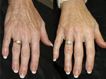 Hand Rejuvenation In New York City