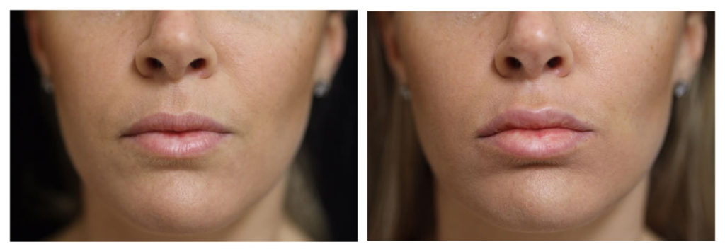 lip-augmentation-options-such-as-restylane-juvederm-volbella