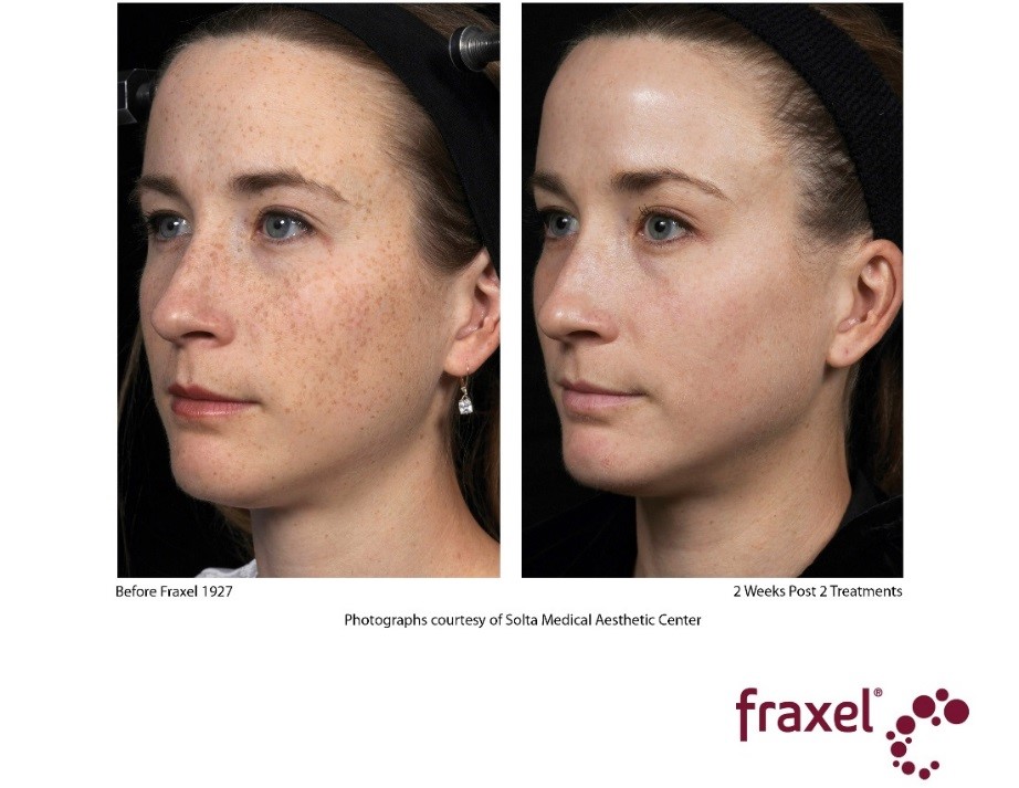 How Does Fraxel Laser Treatment Work Fraxel Laser Procedures Nyc