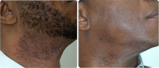 GentleYAG® Laser Hair Removal for Darker Skin Tones