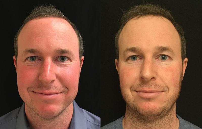 Treating Rosacea With The V Beam Laser 