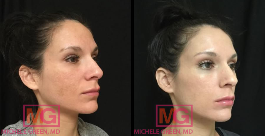Skin Discoloration Treatment Before and After Photo Gallery - Orlando,  Florida - Primera Plastic Surgery