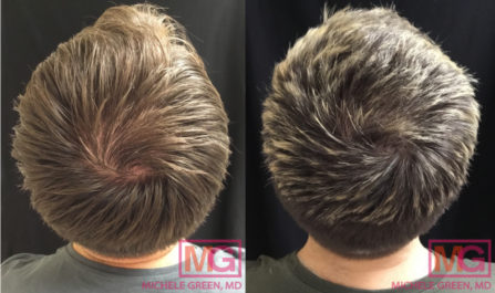 PRP Hair Loss, Hair Treatment & Restoration NYC - Procedures & Costs