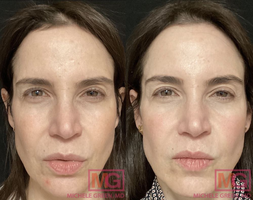 lactic acid peel before after