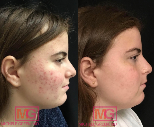 Cystic Acne Treatment Dr Michele Green Md