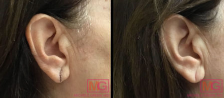 Torn Earlobe Repair NYC & Earlobe Repair Surgery