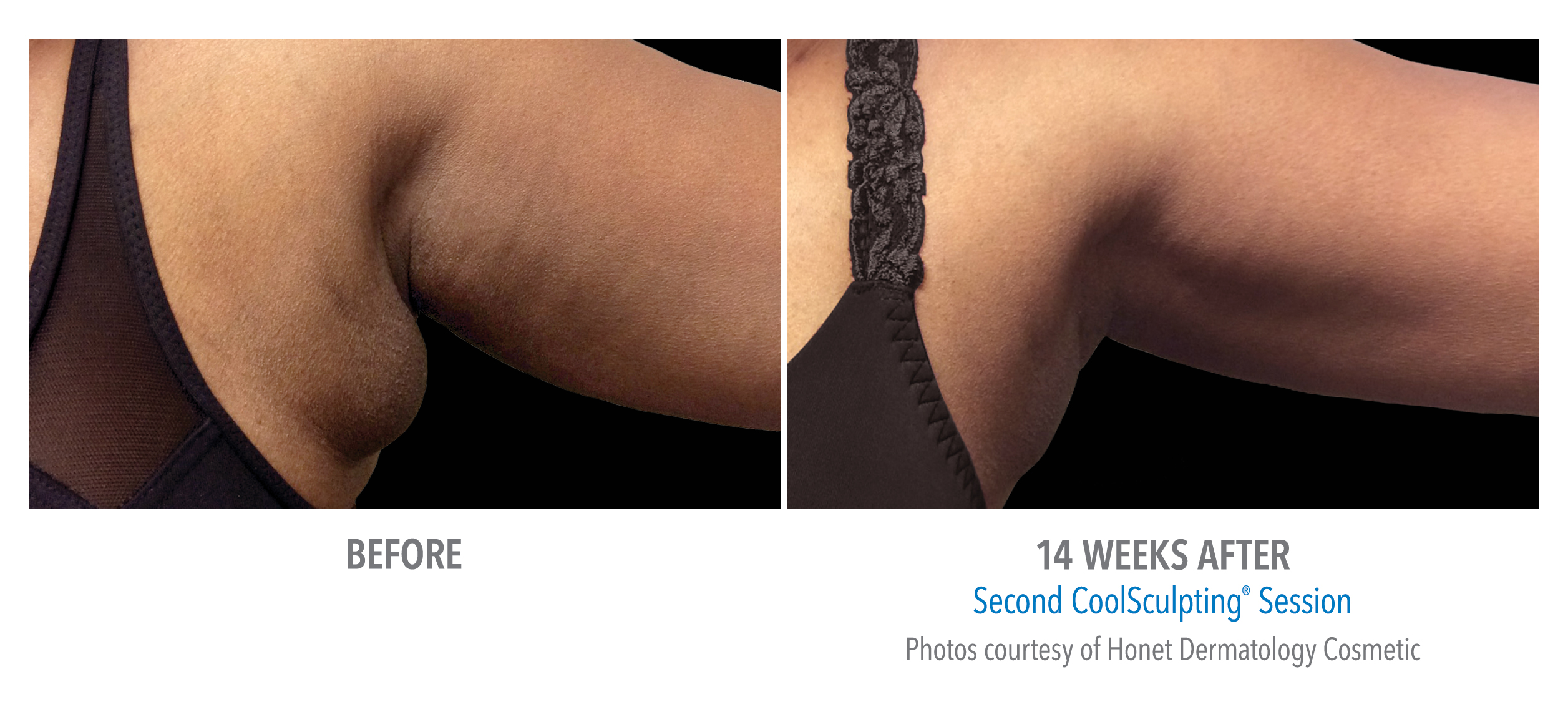 CoolSculpting - Flanks and Bra Strap Area Before & After Gallery - Case 4432