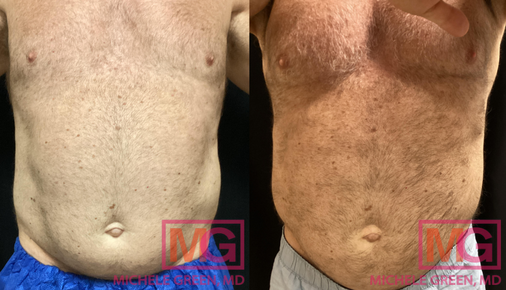 BG 57y0 male 2 sessions Coolsculpting abdomen MGWatermark