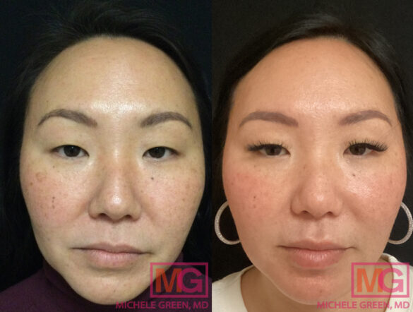 How To Tighten Skin On The Face Without Surgery - Dr. Michele Green M.D.