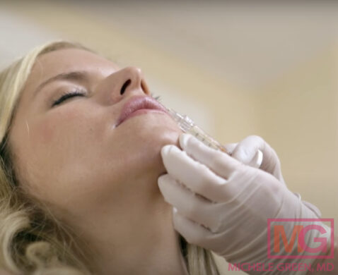 Juvederm Skinvive For Cheek Area Skinvive By Juvederm Dr Michele Green M D