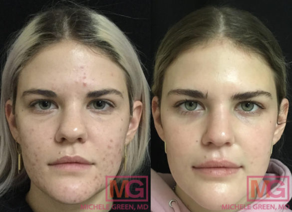 Ice Pick Acne Scars Dr Michele Green Md
