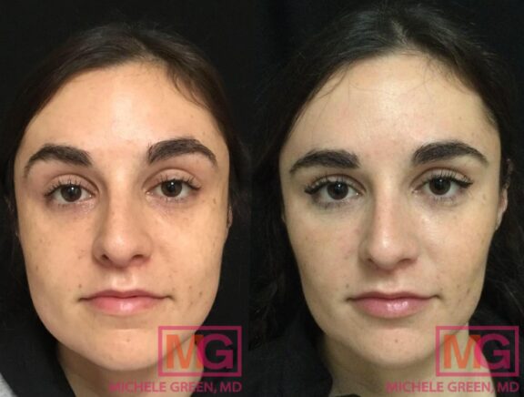 Botox TMJ (Temporomandibular Joint), TMD & Jaw Area