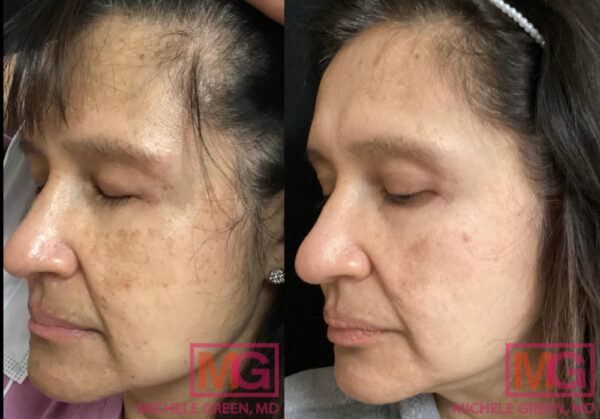 Tranexamic Acid Pill For Melasma Melasma Treatment With Oral Tranexamic Acid Dr Michele