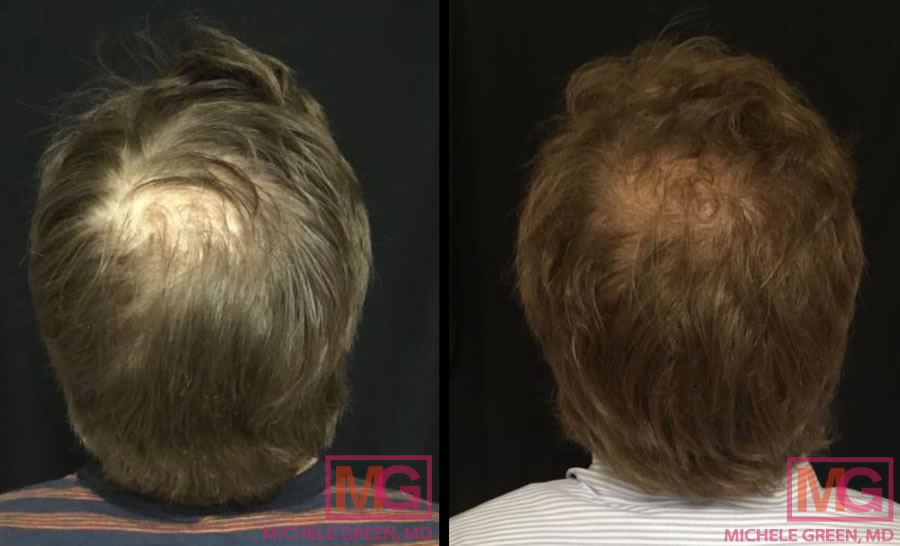 DK 35 PRP hair loss 2 month 2 treatment BACK TOP MGWatermark