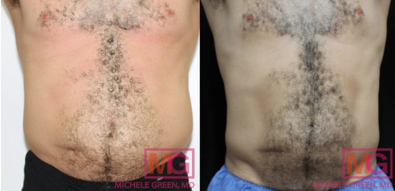 CoolSculpting for Arms, Upper Arm CoolSculpting Treatment NYC - Dr. Michele  Green M.D.