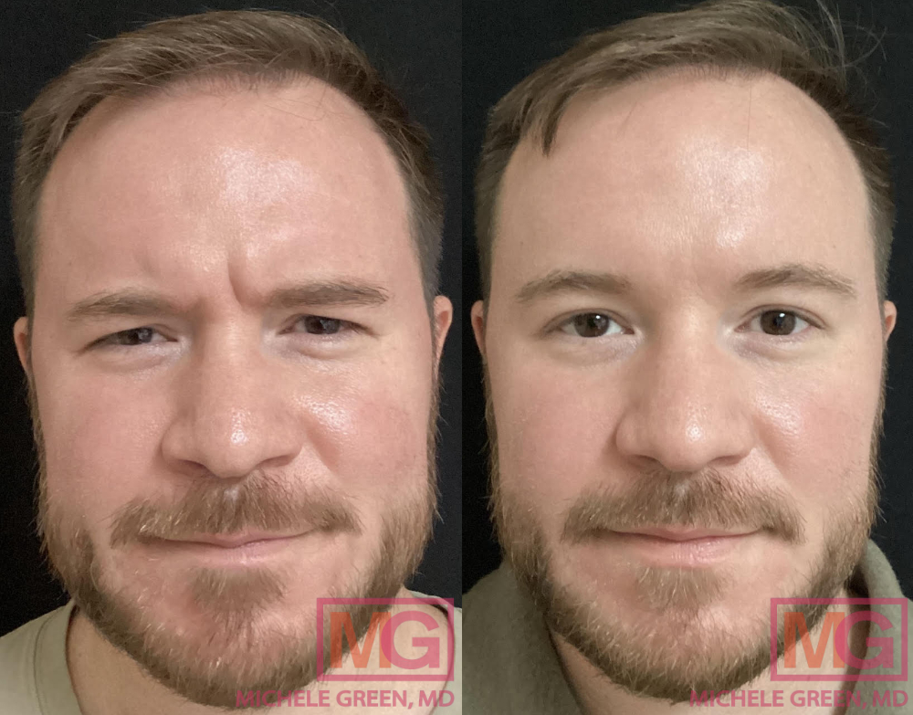 https://www.michelegreenmd.com/wp-content/uploads/DW-31-yo-male-before-and-after-Botox-glabella-and-masseter-3-weeks-apart-MGWatermark.jpg