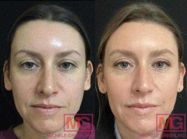 Juvederm NYC - Juvederm Injections For Lines & Wrinkles