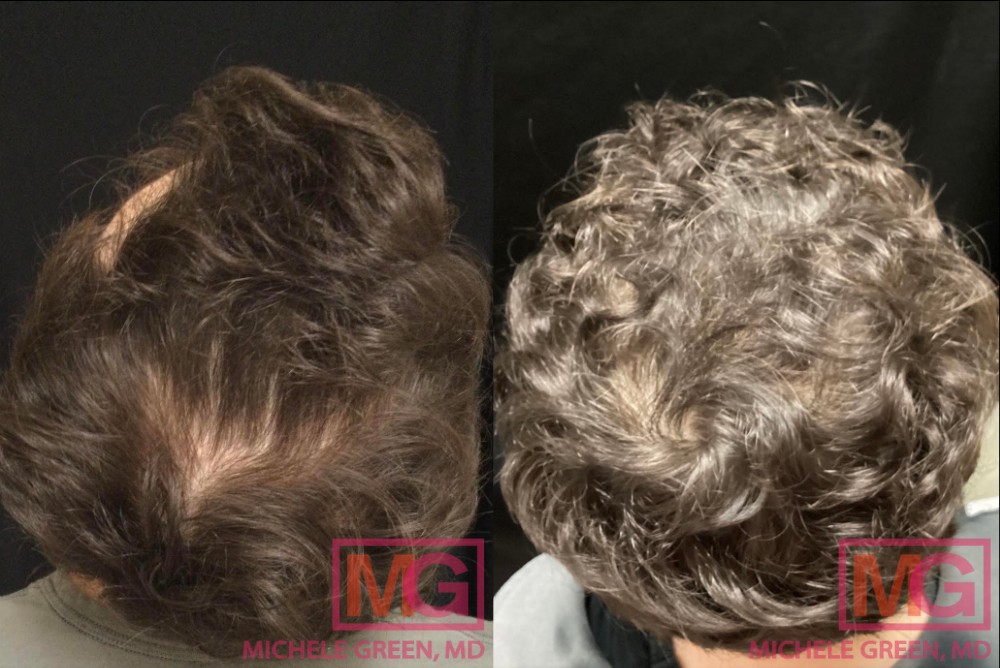 Oral Minoxidil Hair Loss, Treatment for Hair & Balding
