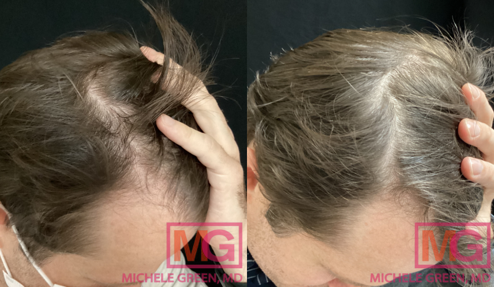 GP Before and After 4 PRP Hair Treatments 7 months FRONT 2 MGWatermark