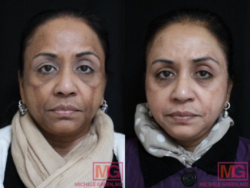 Chemical Peels Before & After Photos - Dr. Michele Green M.D.