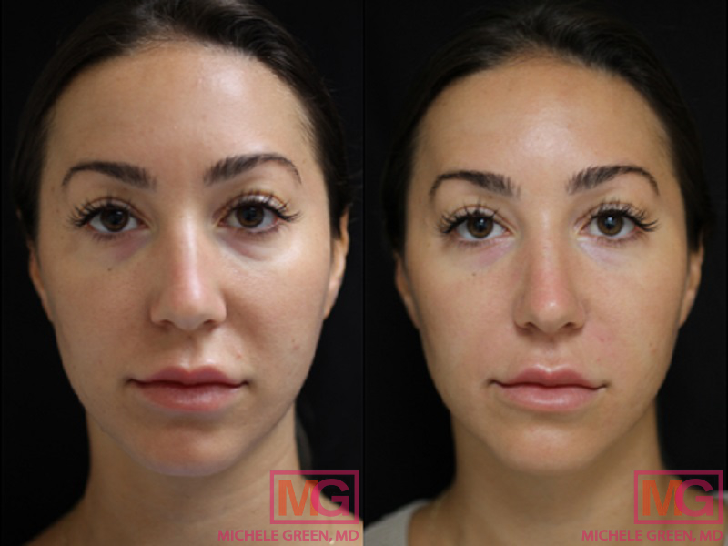 35-44 year old woman treated with Restylane Lyft