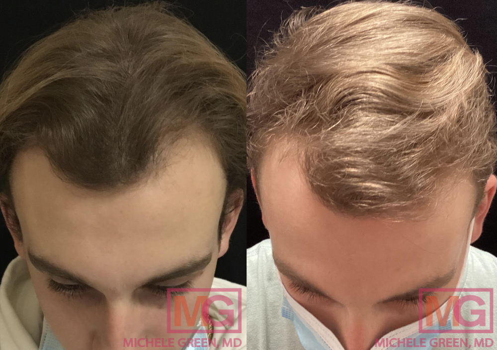 https://www.michelegreenmd.com/wp-content/uploads/JA-Before-and-after-3-PRP-treatment-sessions-4-months-apart-FRONT-MGWatermark.jpg
