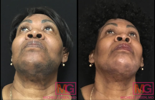 Tranexamic Acid Pill For Melasma Melasma Treatment With Oral