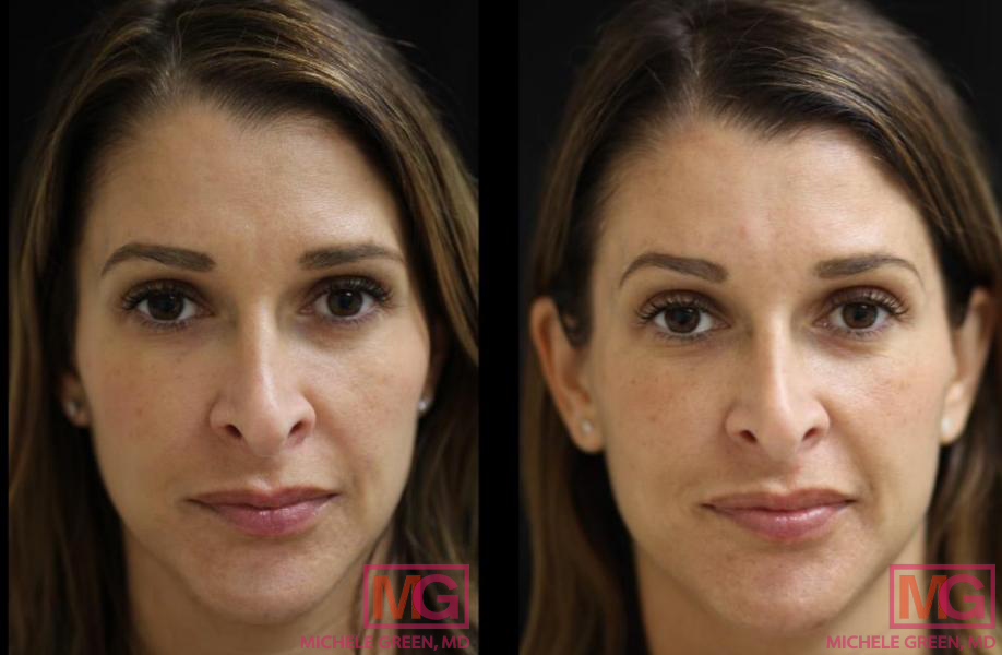 Results of Before & After Using Restylane Lyft - Sobel Skin