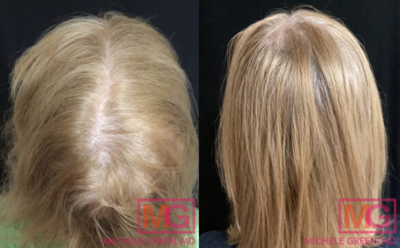 PRP Hair Loss, Hair Treatment & Restoration NYC - Procedures & Costs