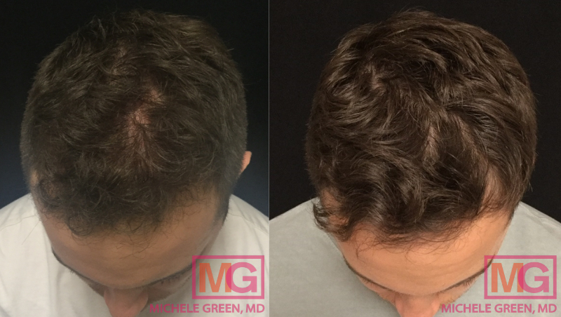 https://www.michelegreenmd.com/wp-content/uploads/JS-26-6-Months-Before-and-After-PRP-Hair-MGWatermark.jpg
