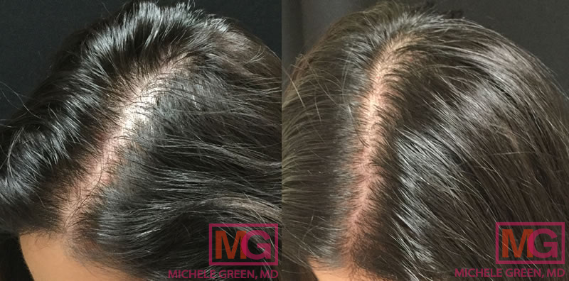 14 Prf Before And After Hair Calamparousia