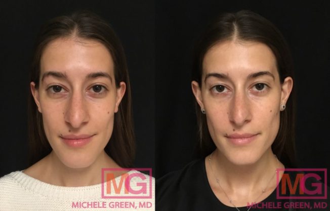 Restylane Eyelight Under-Eye Filler - Dr. Michele Green M.D.