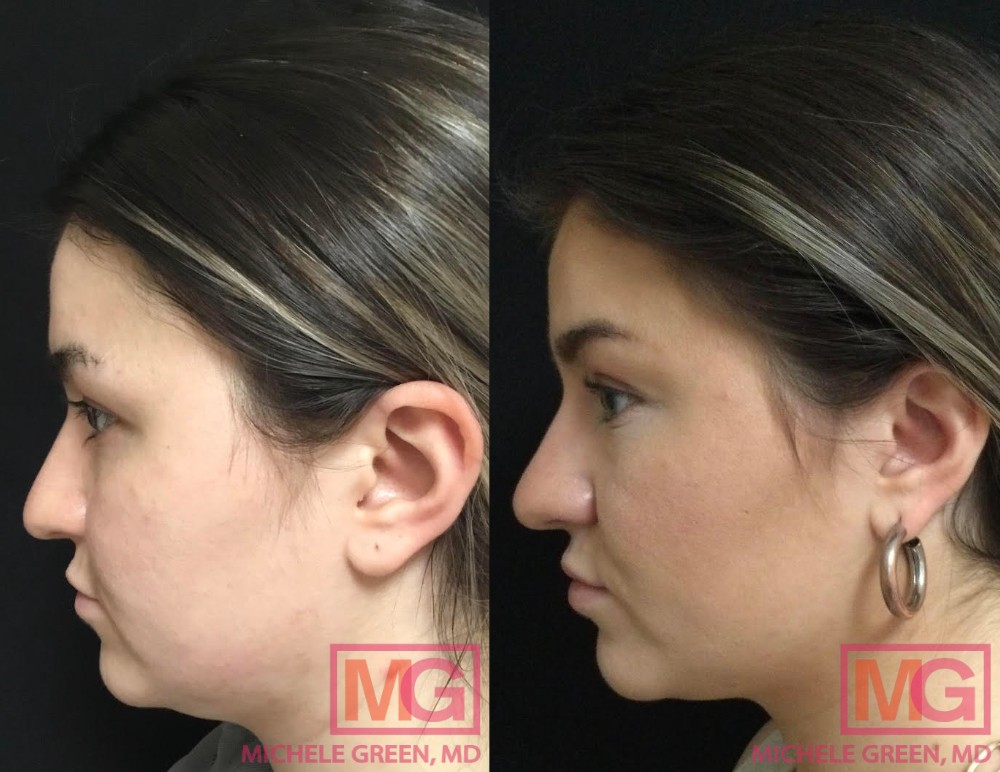 Brabella: Kybella for Bra Fat in NYC Dr Michele Green M D