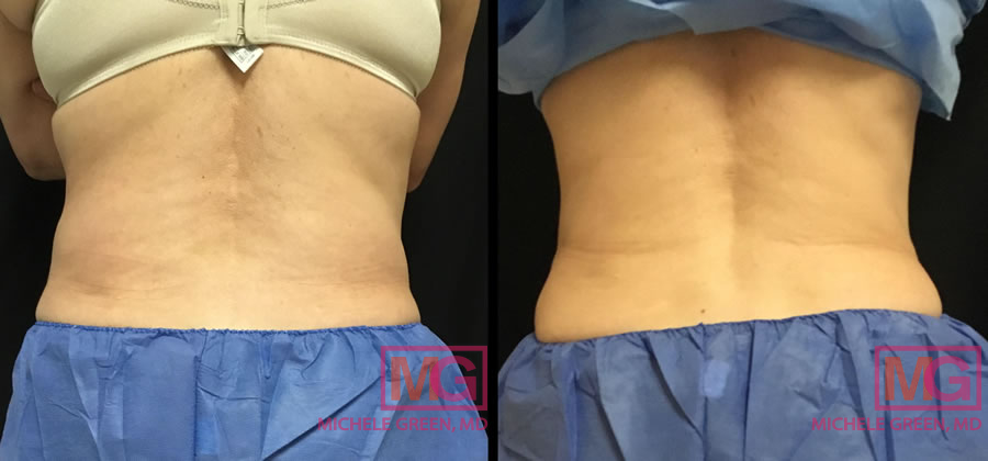 CoolSculpting of the upper and lower back. A, A 68‐year‐old woman
