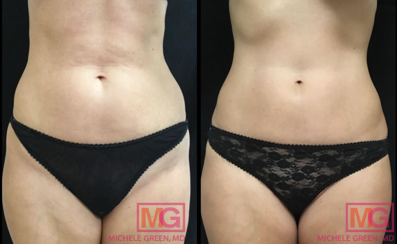 CoolSculpting Stomach/Abdomen – Before and After, Reviews, Cost