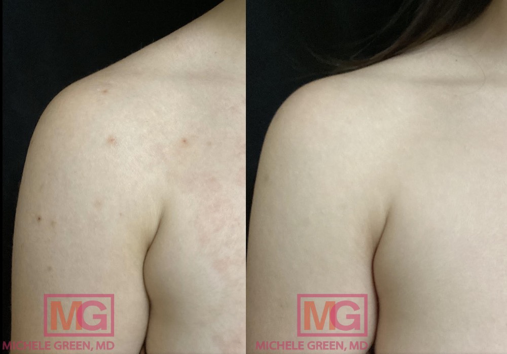 https://www.michelegreenmd.com/wp-content/uploads/LT-25-yo-female-before-and-after-Kybella-x3-in-bra-fat-4-months-apart-MGWatermark.jpg