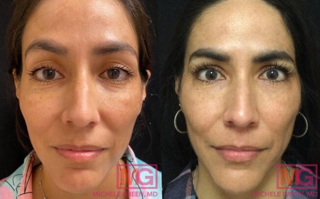 Restylane Eyelight Under-Eye Filler - Dr. Michele Green M.D.