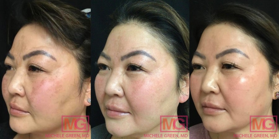Do Chemical Peels Help with Melasma? - Dr. Michele Green M.D.
