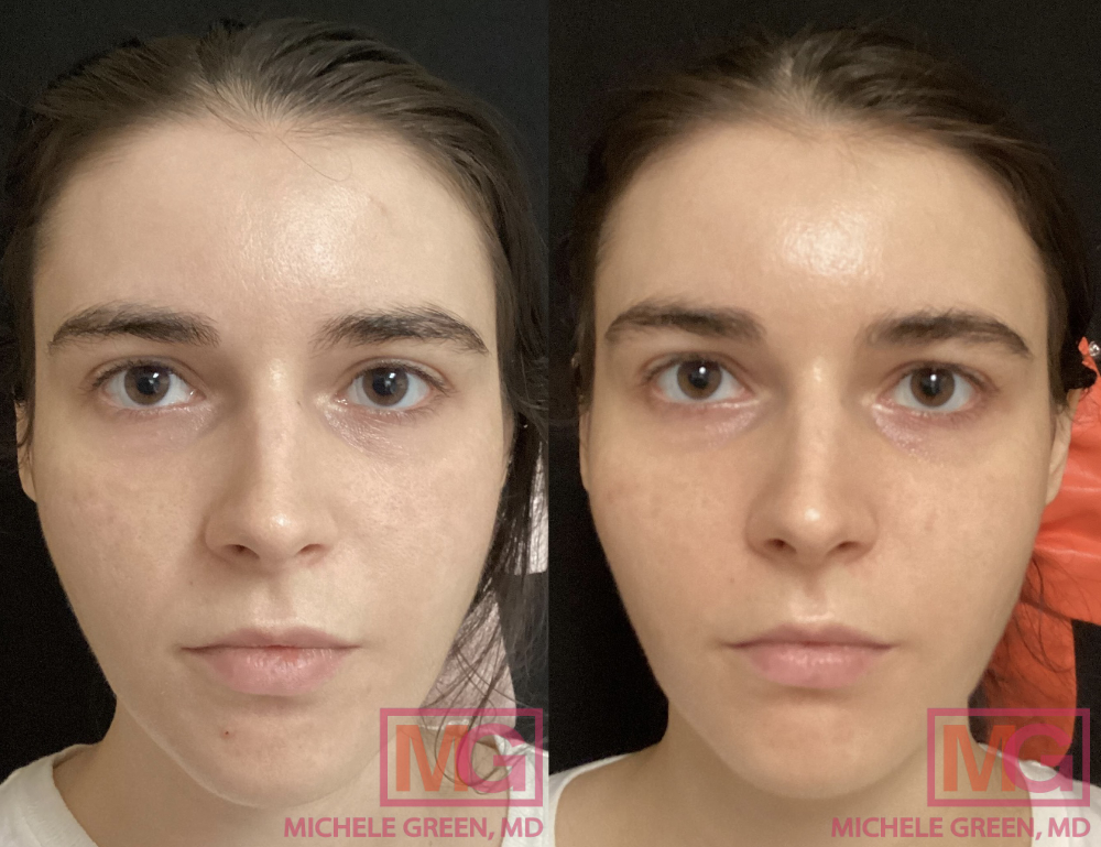 Results of Before & After Using Restylane Lyft - Sobel Skin