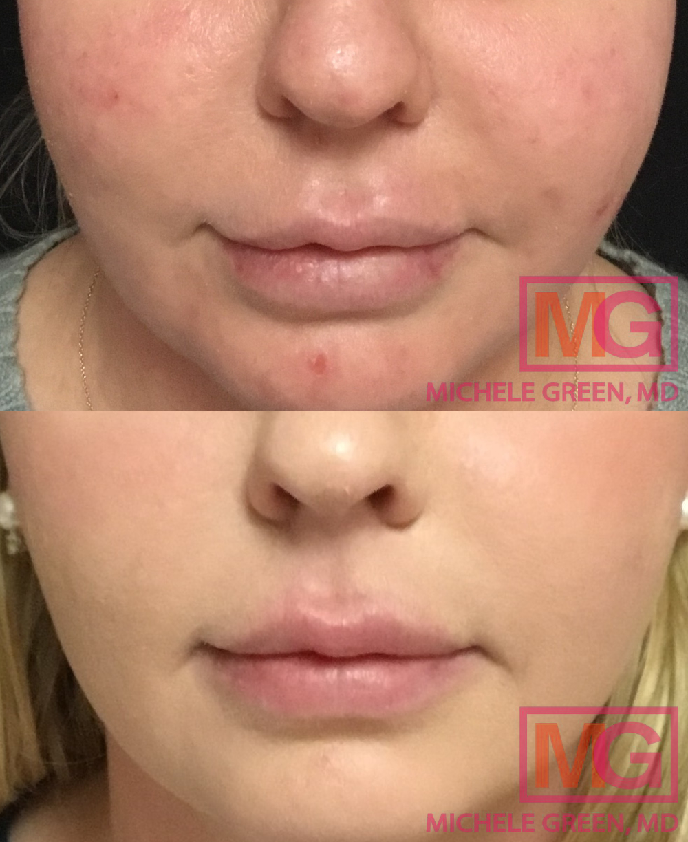 Lip Fillers Before And After Photos Dr Michele Green Md