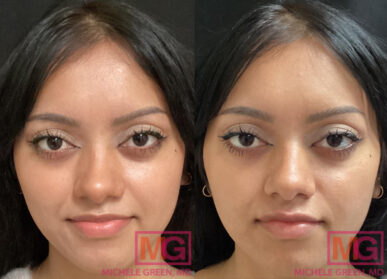 Juvederm Injections For Lip Augmentation & Juvederm Volbella NYC