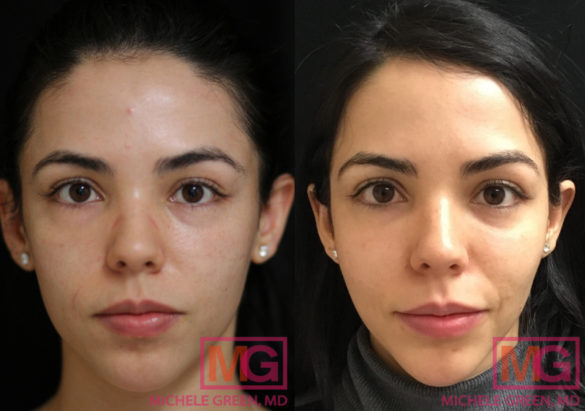 Microneedling Under Eyes, Around Eyes & Eye Bags - Dr. Michele Green M.D.