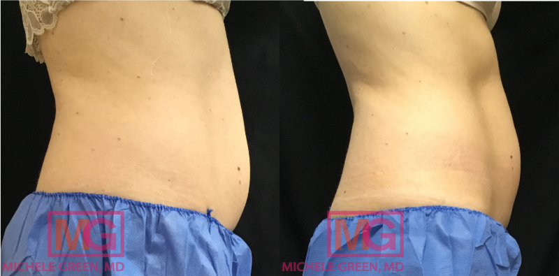 Kybella For Stomach Fat - Dr. Michele Green M.D.