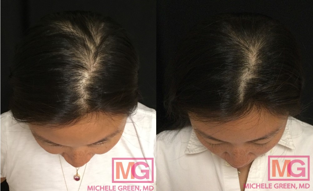 Oral Minoxidil Hair Loss, Treatment for Hair & Balding