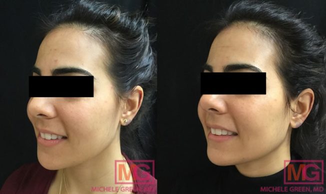 Chemical Peels Before & After Photos - Dr. Michele Green M.D.