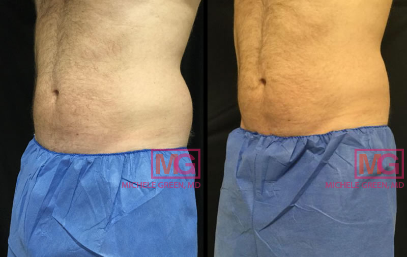 Areas Of The Body Treated With CoolSculpting