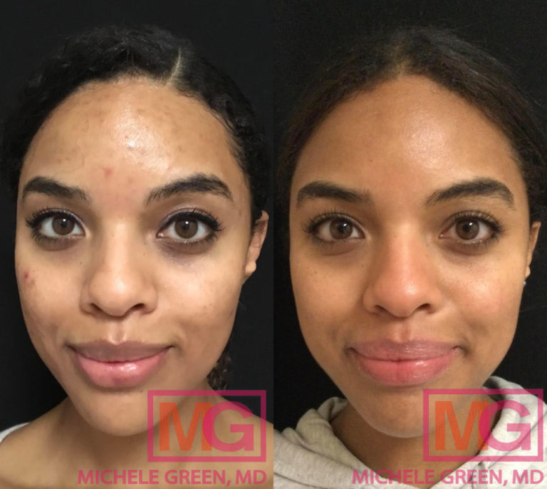 acne-scar-treatment-for-dark-skin-nyc-darker-skin-tone-dermatology