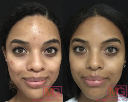 Accutane for Acne Treatment - Dr. Michele Green M.D.