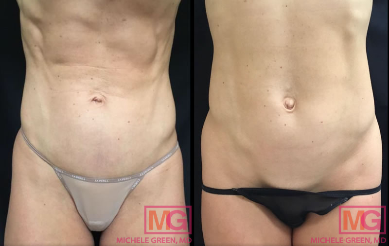3 Popular Body Contouring Treatments in NYC to Start in Spring