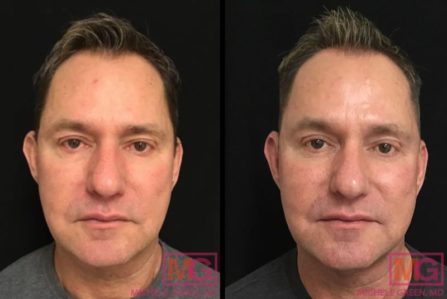 Fraxel Laser Before & After Photos - Dr. Michele Green M.D.